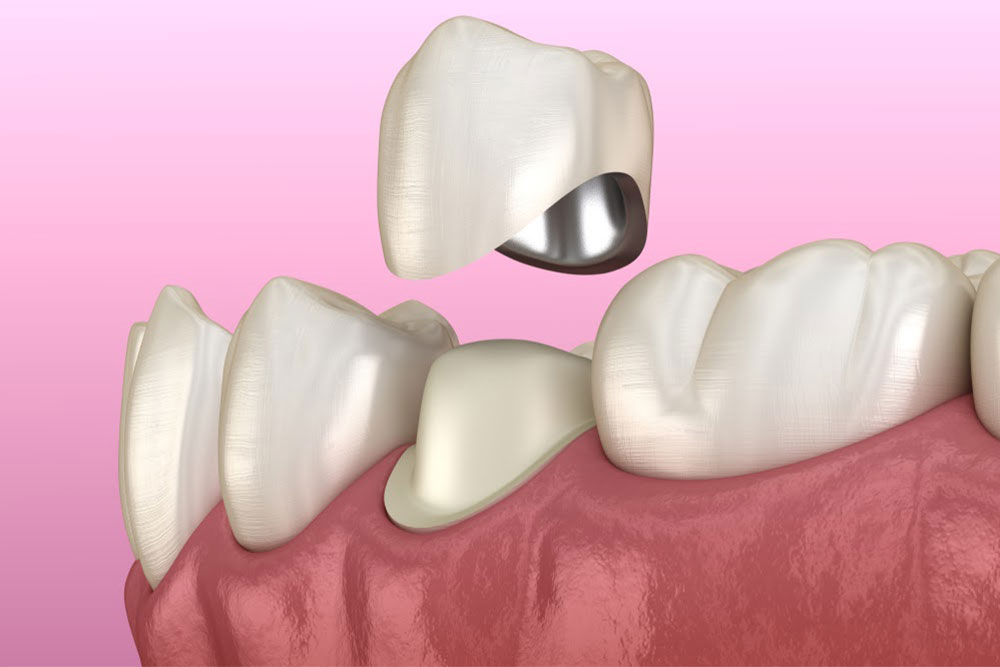 Как ставят коронки на зуб: технологии современной стоматологии